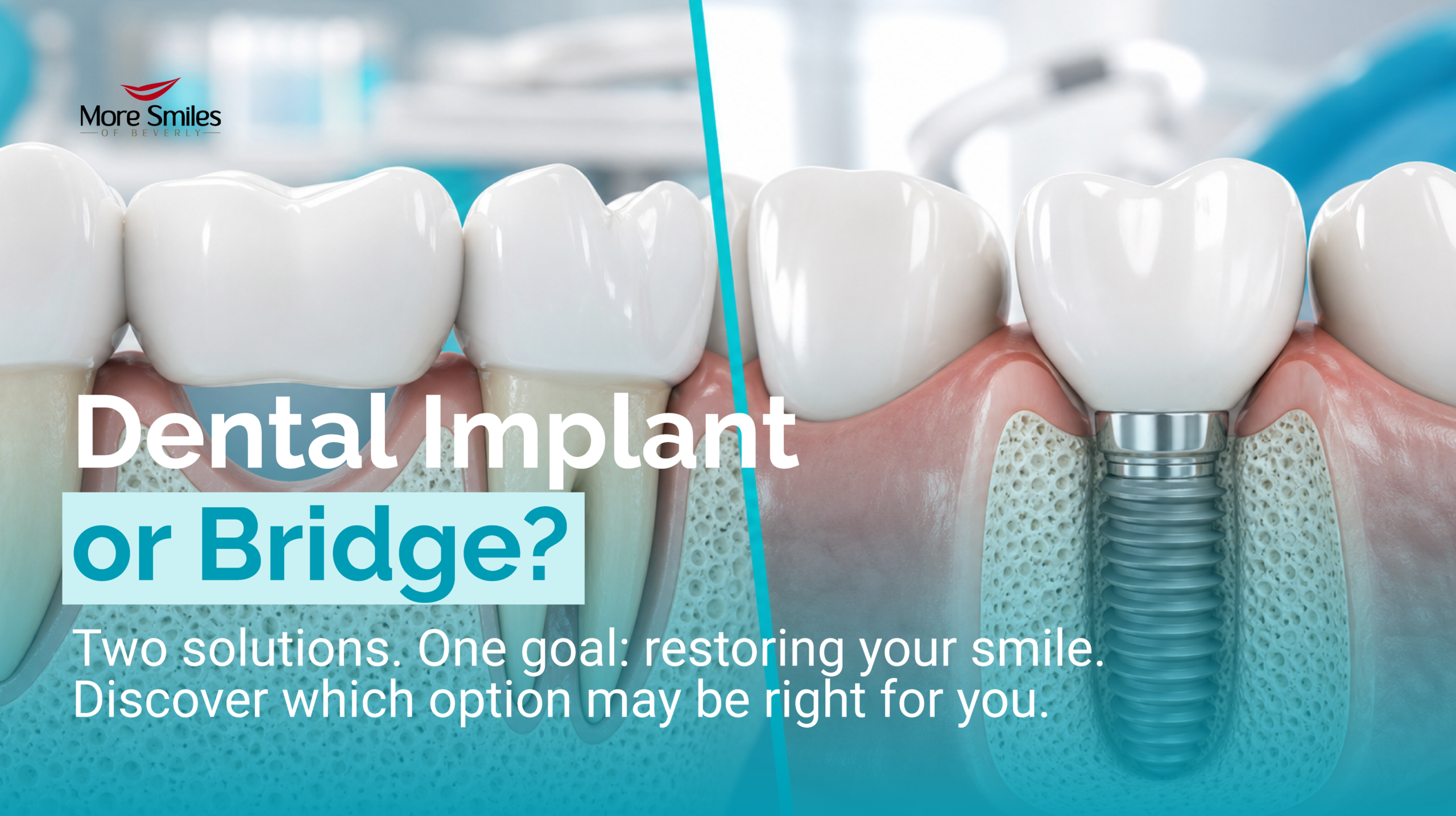Dental Implant or Bridge - More Smiles of Beverly