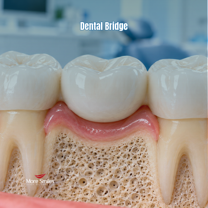 Dental bridge illustration
